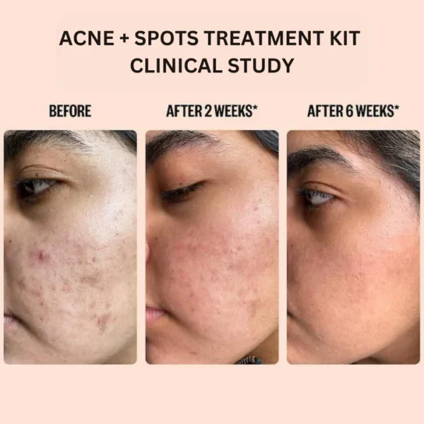 Acne And Spots Treatment Kit (PACK OF 4) - Image 4