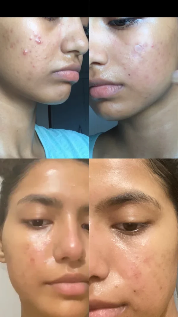 Acne And Spots Treatment Kit (PACK OF 4) - Image 7