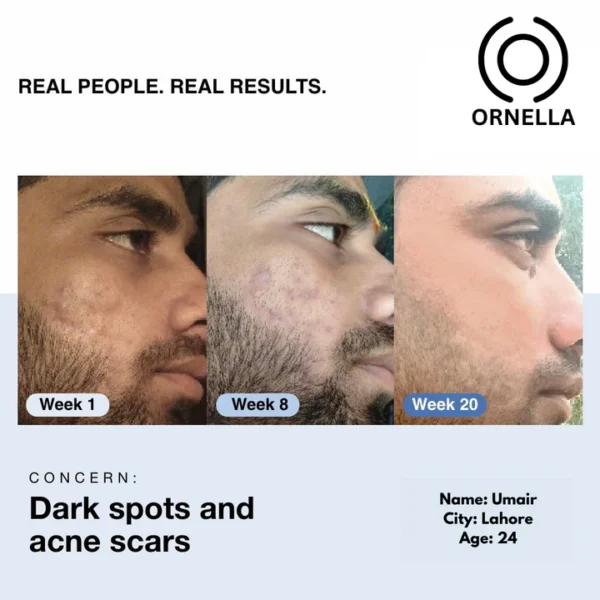 ACNE + PIGMENTATION BUNDLE (PACK OF 3) - Image 4