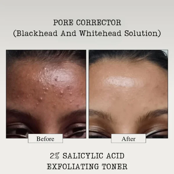 PORE CORRECTOR (Blackhead And Whitehead Solution) - Image 3