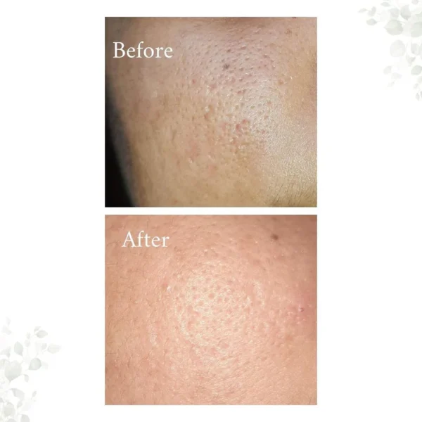 PORE CORRECTOR (Blackhead And Whitehead Solution) - Image 9