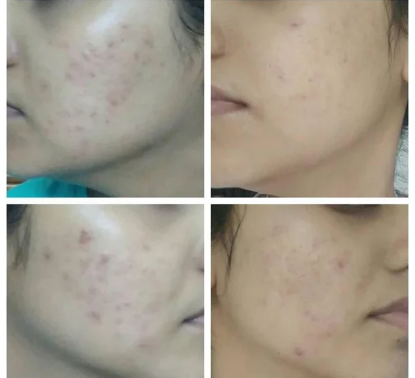 Acne And Spots Treatment Kit (PACK OF 4) - Image 3