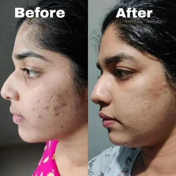 ACNE + PIGMENTATION BUNDLE (PACK OF 3) - Image 2