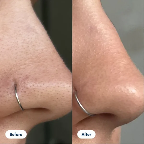 PORE CORRECTOR (Blackhead And Whitehead Solution) - Image 8