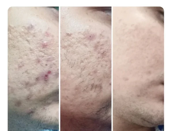 PORE MINIMISING BUNDLE OFFER (PACK OF 4) - Image 3