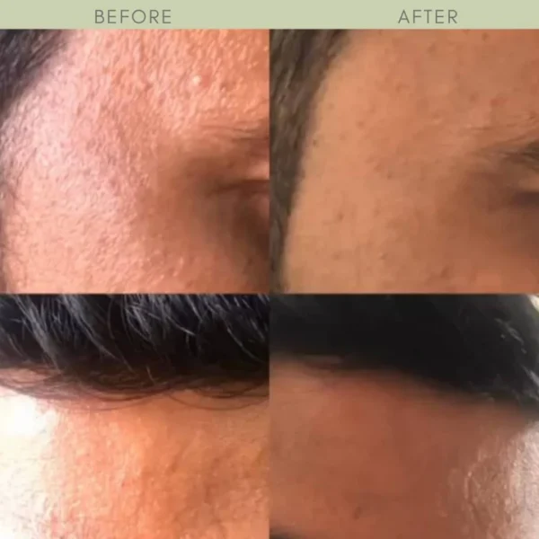 PORE CORRECTOR (Blackhead And Whitehead Solution) - Image 5