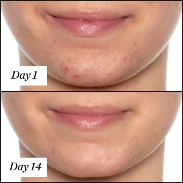 ACNE + PIGMENTATION BUNDLE (PACK OF 3) - Image 3